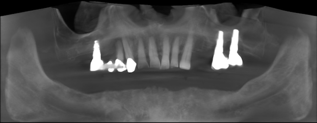 teljes-szajrehabilitacio-all-on-4-technologia-implantatum-beultetes-debrecen