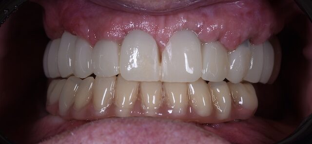 implantatum-beultetes-utan-teljes-szajrehabilitacio-debrecen