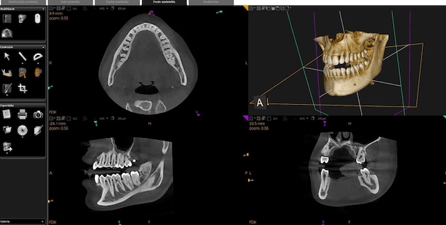 fogaszati-ct-felvetel-implantatum-beultetes-elott-debrecen