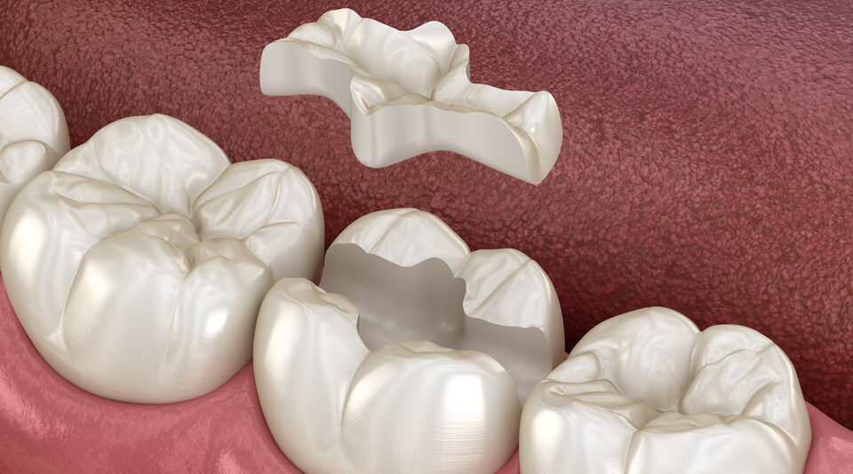 fogaszati-betet-inlay-onlay-overlay-forma-dental-clinic