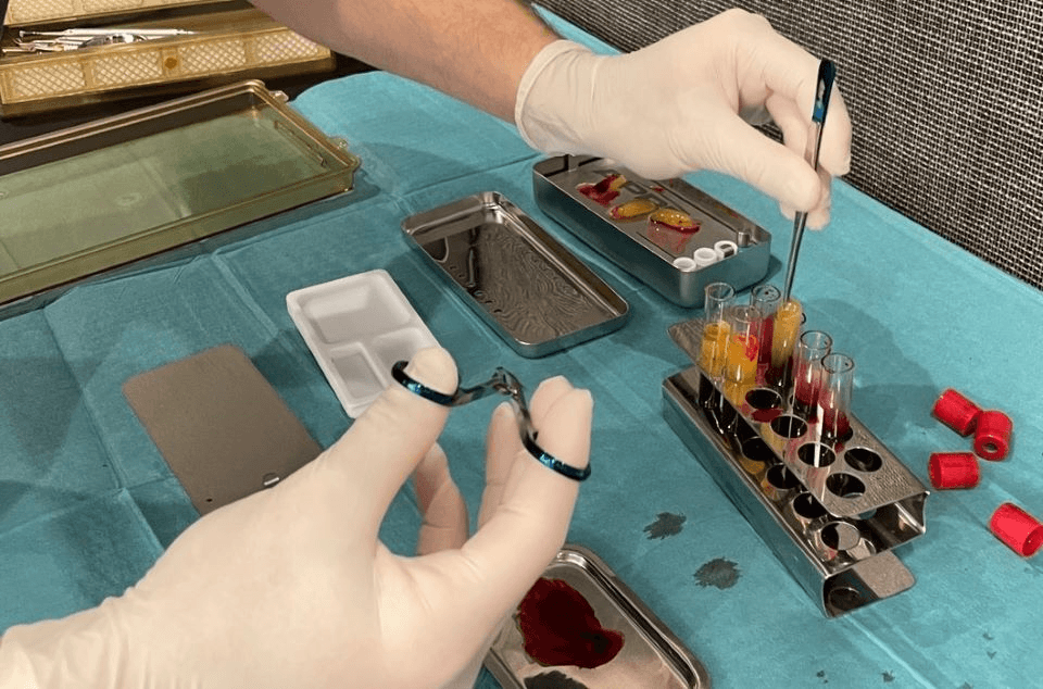 implantatum-beultetes-PRF-technologia-forma-dental