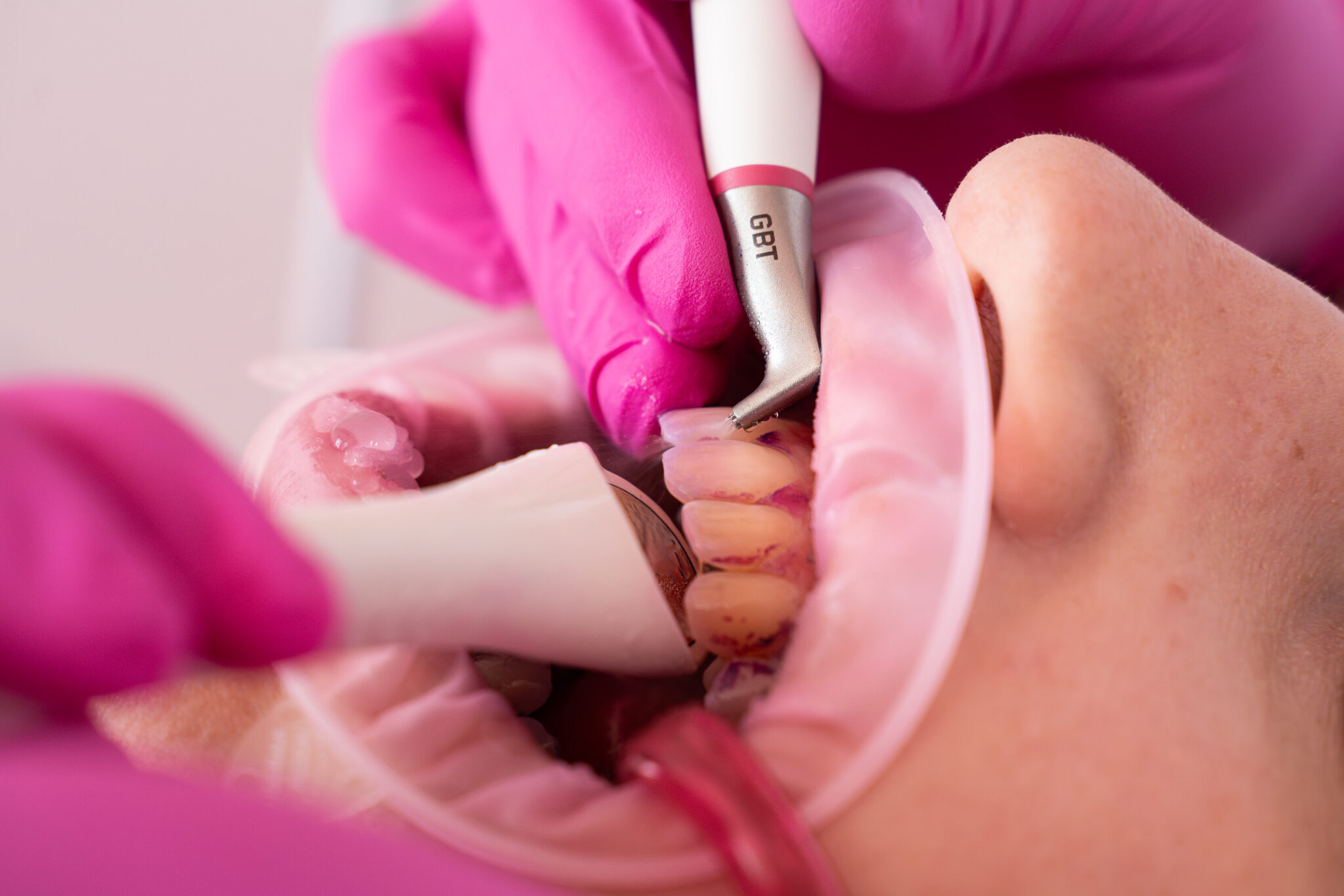 iranyitott-biofilm-terapia-forma-dental